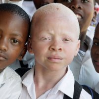 Efforts to Quell Albino "Magic" Murders in East Africa Underway